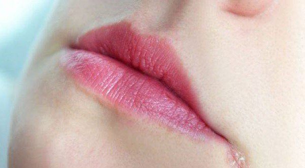 Ранки в уголках губ – как и чем лечить трещинки? 