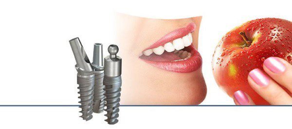 Имплантация зубов и ее преимущества 