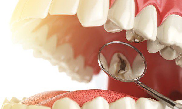Кариес — причины и способы лечения зубов без боли. 