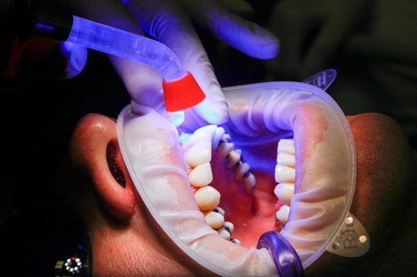 Имплантация зубов в Москве по современным технологиям 