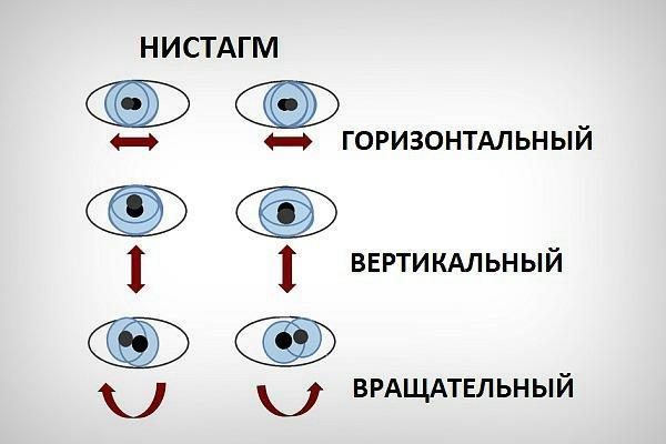 Нистагм – нейроофтальмологическое расстройство. 